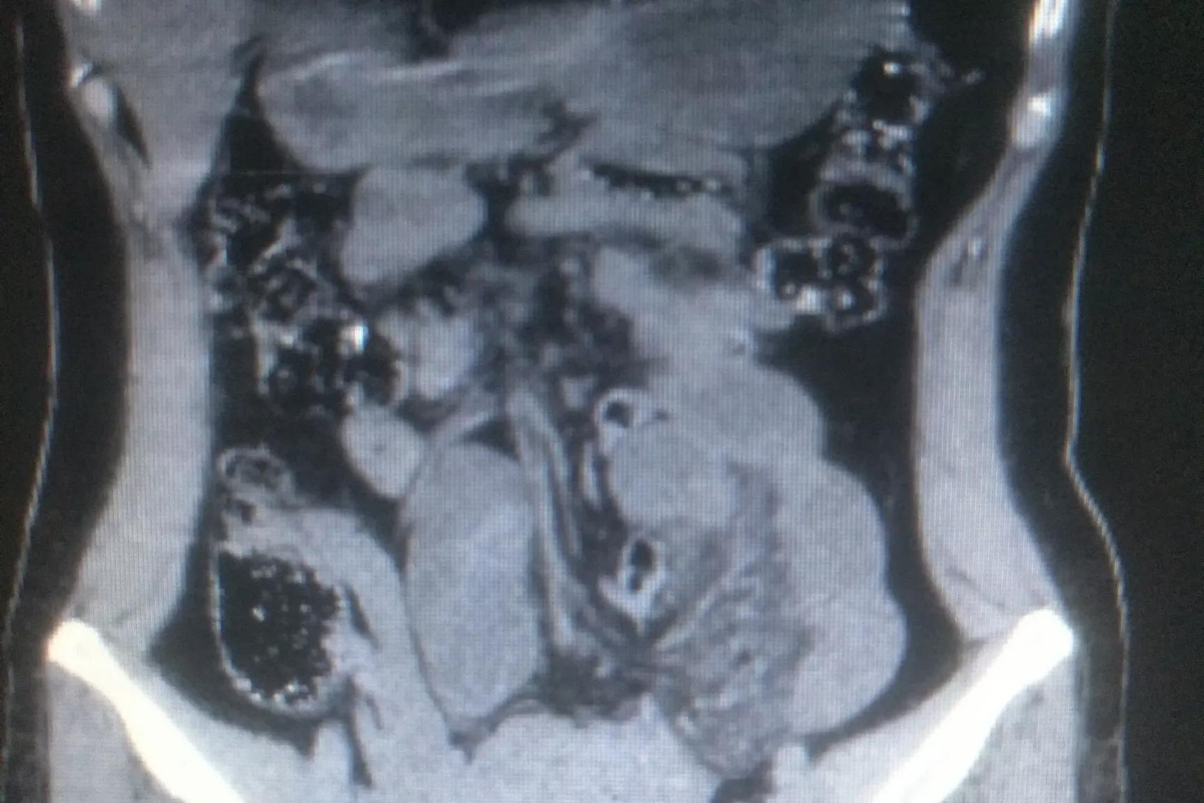 右腹部疼痛是尿道结石吗,右下腹疼痛是什么结石