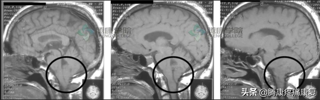 紧张性头痛如何治疗视频,紧张性头痛的临床表现及诊断