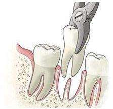 拔牙的6种注意事项！处理不好可能会有并发症