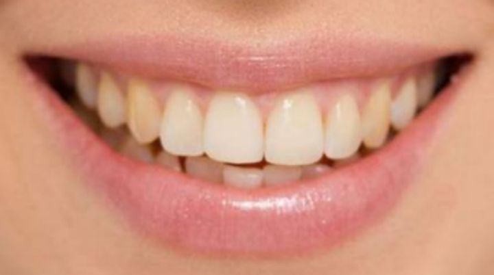 18岁女孩牙齿磨了,门牙是烤瓷牙可以矫正牙齿吗