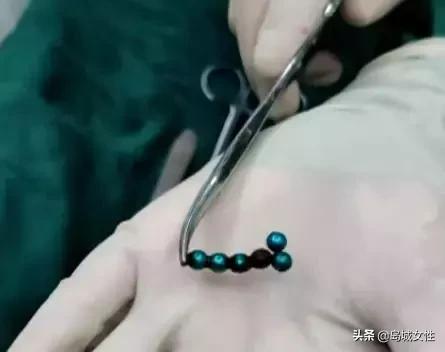 8岁男孩误吞5厘米钢钉,惊险9岁男孩误吞3厘米图钉