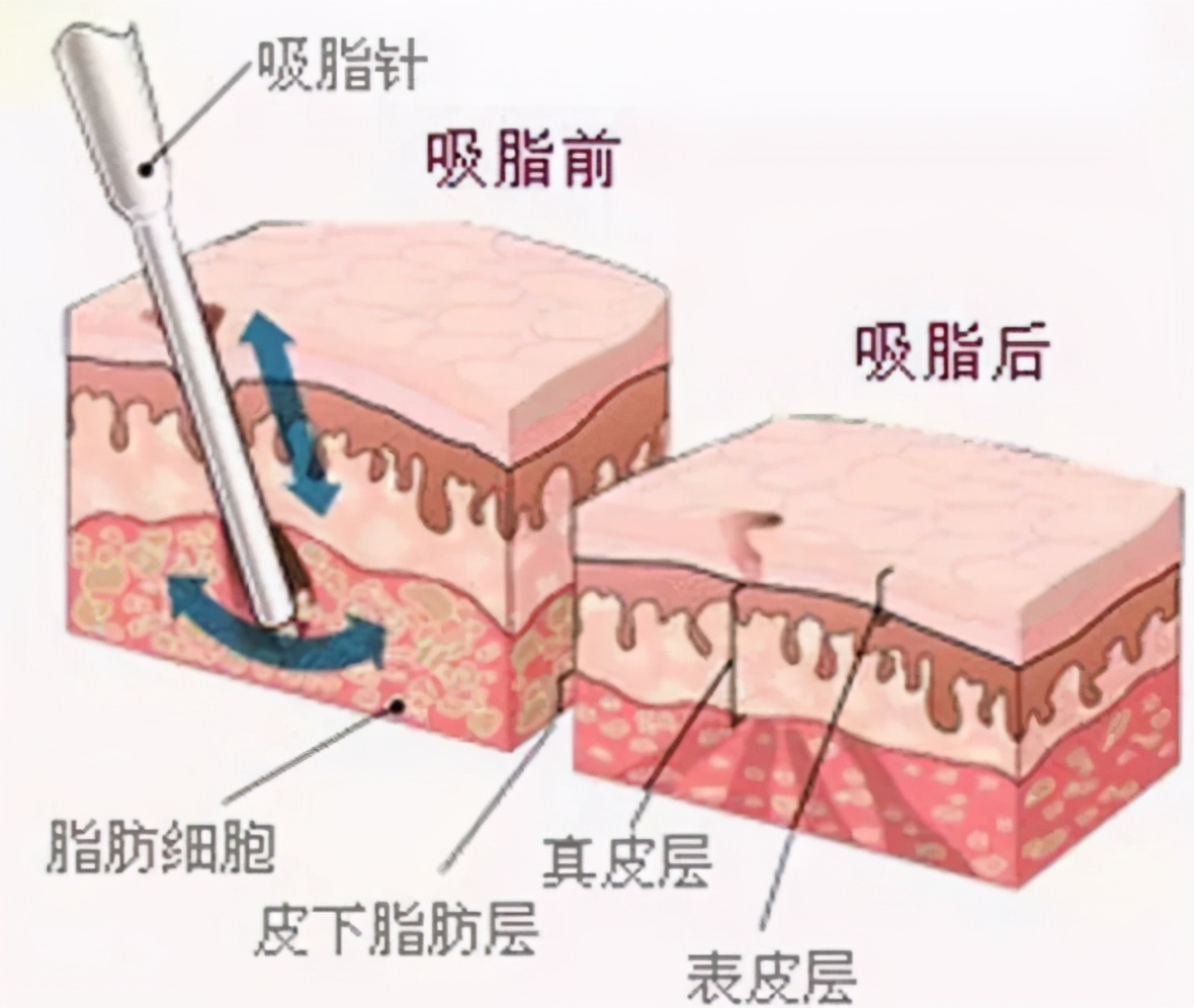 医美踩过的坑自述,医美经验100个坑