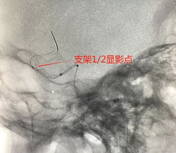 Tubridge®治疗多发性动脉瘤