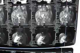 淋巴血管畸形治疗费用,淋巴静脉畸形治疗