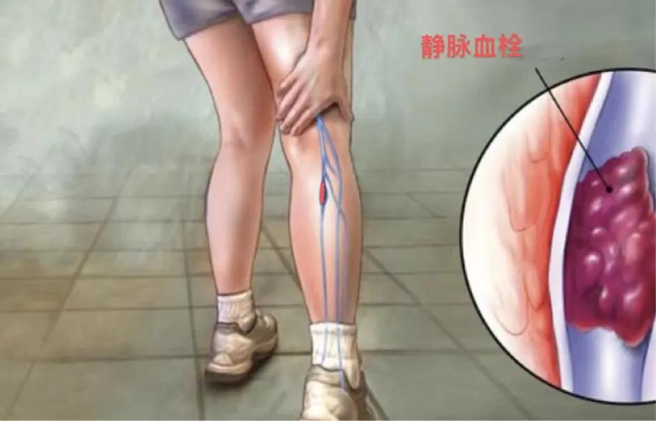 张强医生集团启动静脉血栓“空中门诊”(每日限量提供体验兑换券