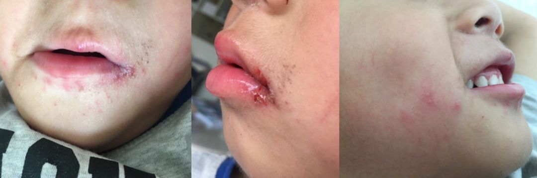 小孩嘴巴上火了红肿溃烂不吃饭,小孩口溃烂是咋回事