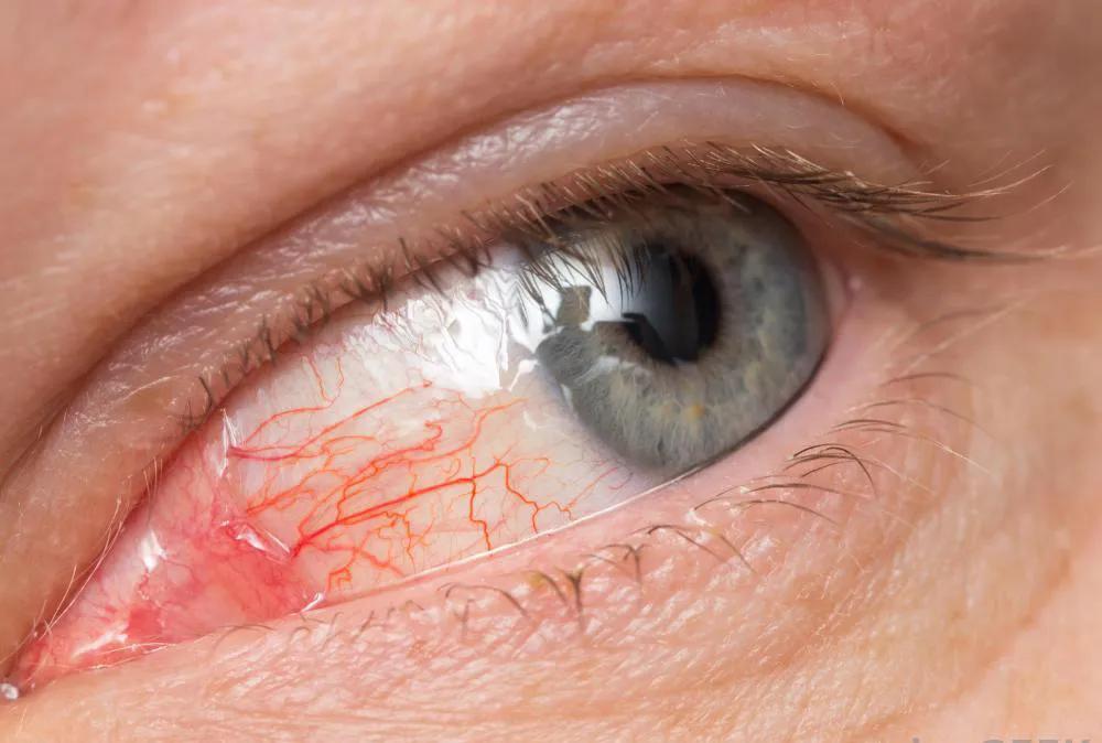 眼睛突然又红又肿，不敢去医院，应该怎么办？