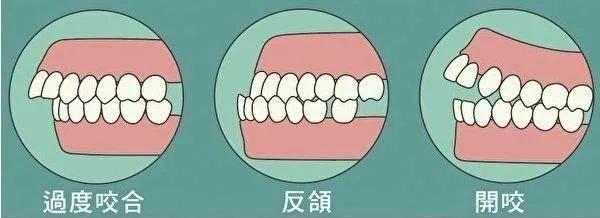 吃饭咬到嘴了是因为想吃肉,吃饭咬到舌头是馋肉吗