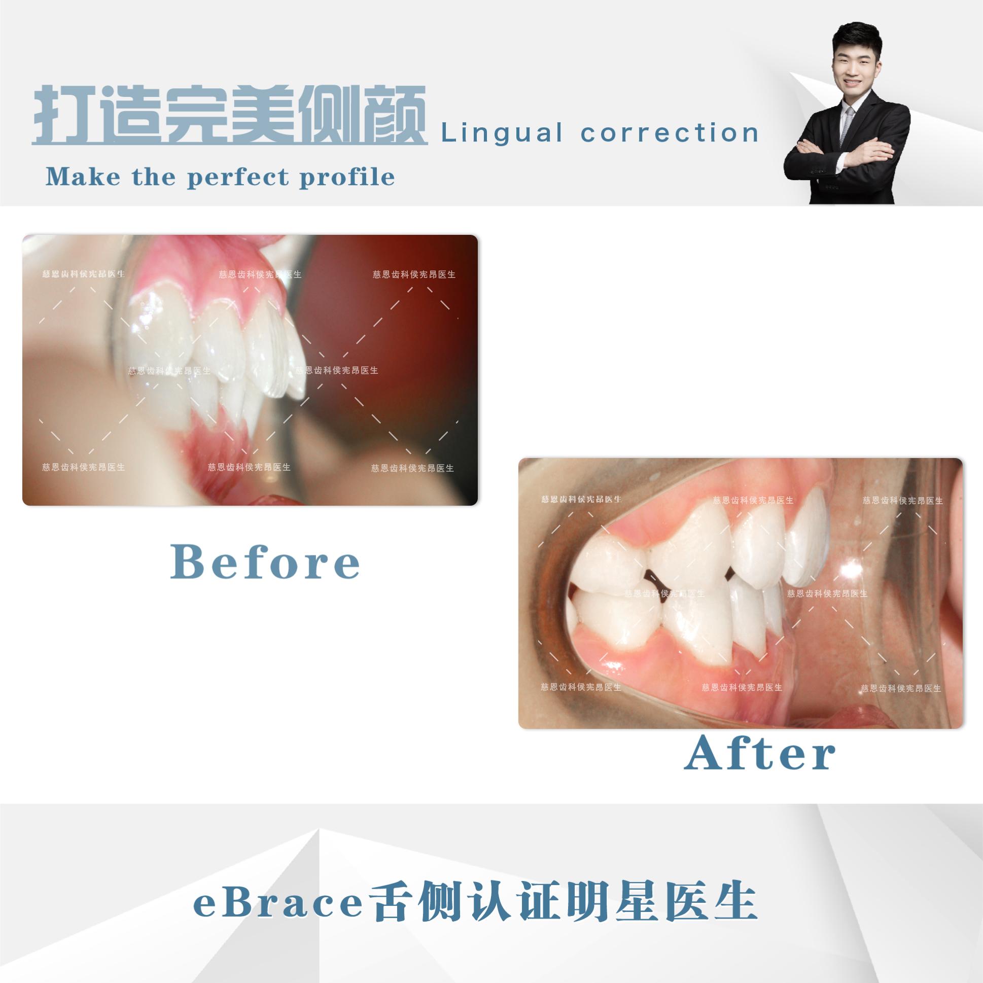 牙突怎么矫正,怎么矫正嘴突