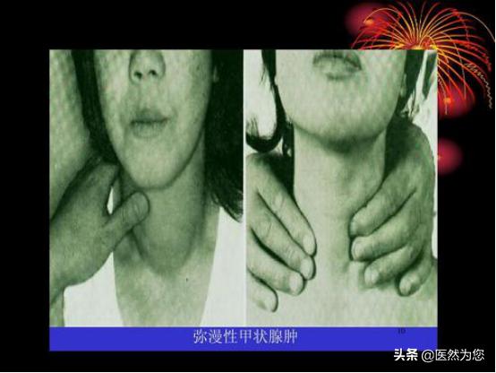 甲亢会老得快吗,吃甲亢药脖子为什么会变大