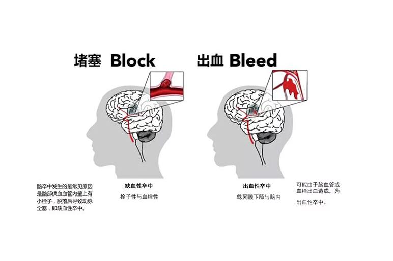 中老年人,中风7大危险因素,不可不知,夏季需做好六种警惕