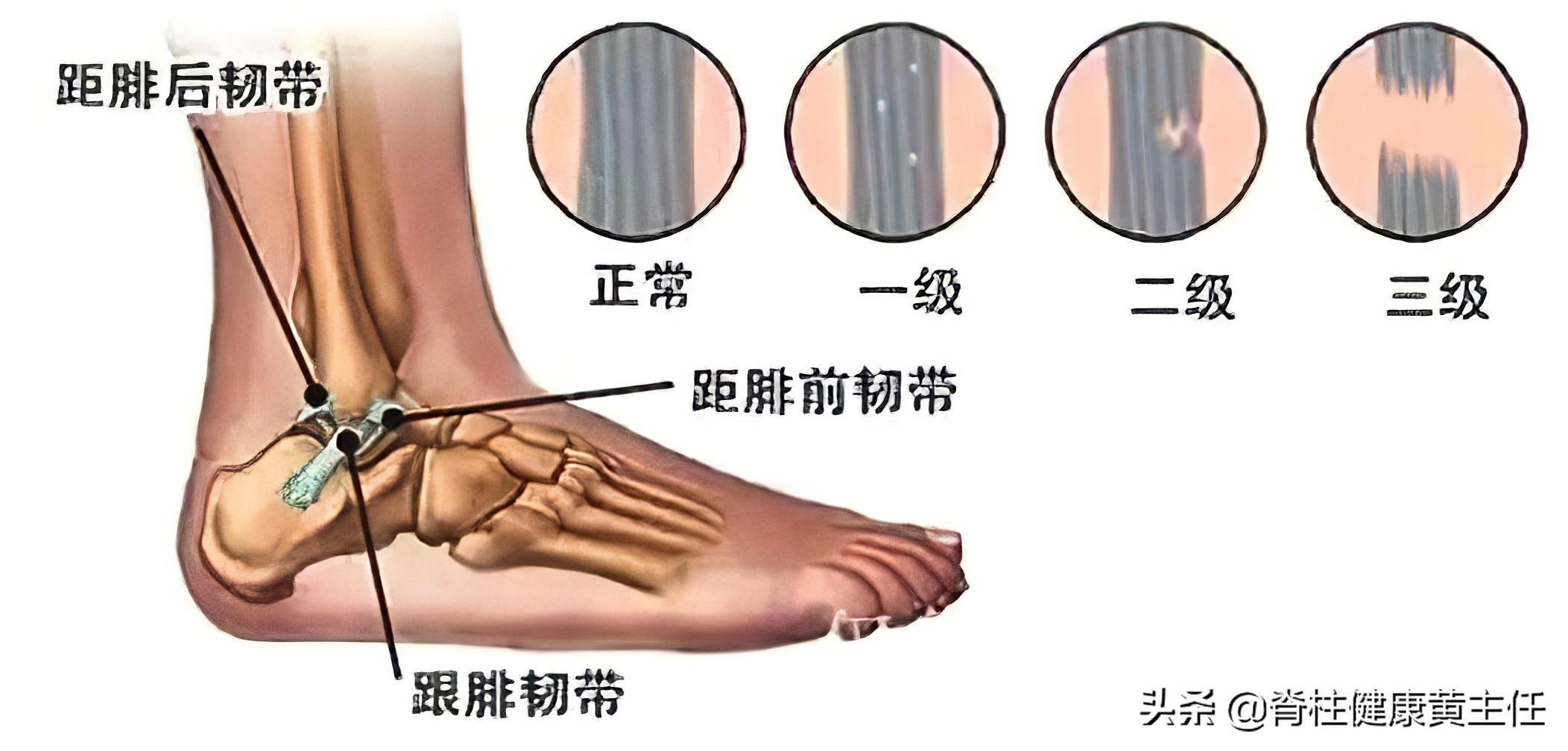 踝关节扭伤治疗手法,踝关节扭伤康复训练手法