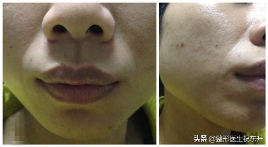 法令纹凸显怎么办,胖起来泪沟和法令纹会减轻吗