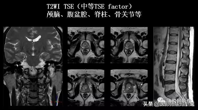 飞利浦磁共振图像操作,飞利浦磁共振成像序列及应用
