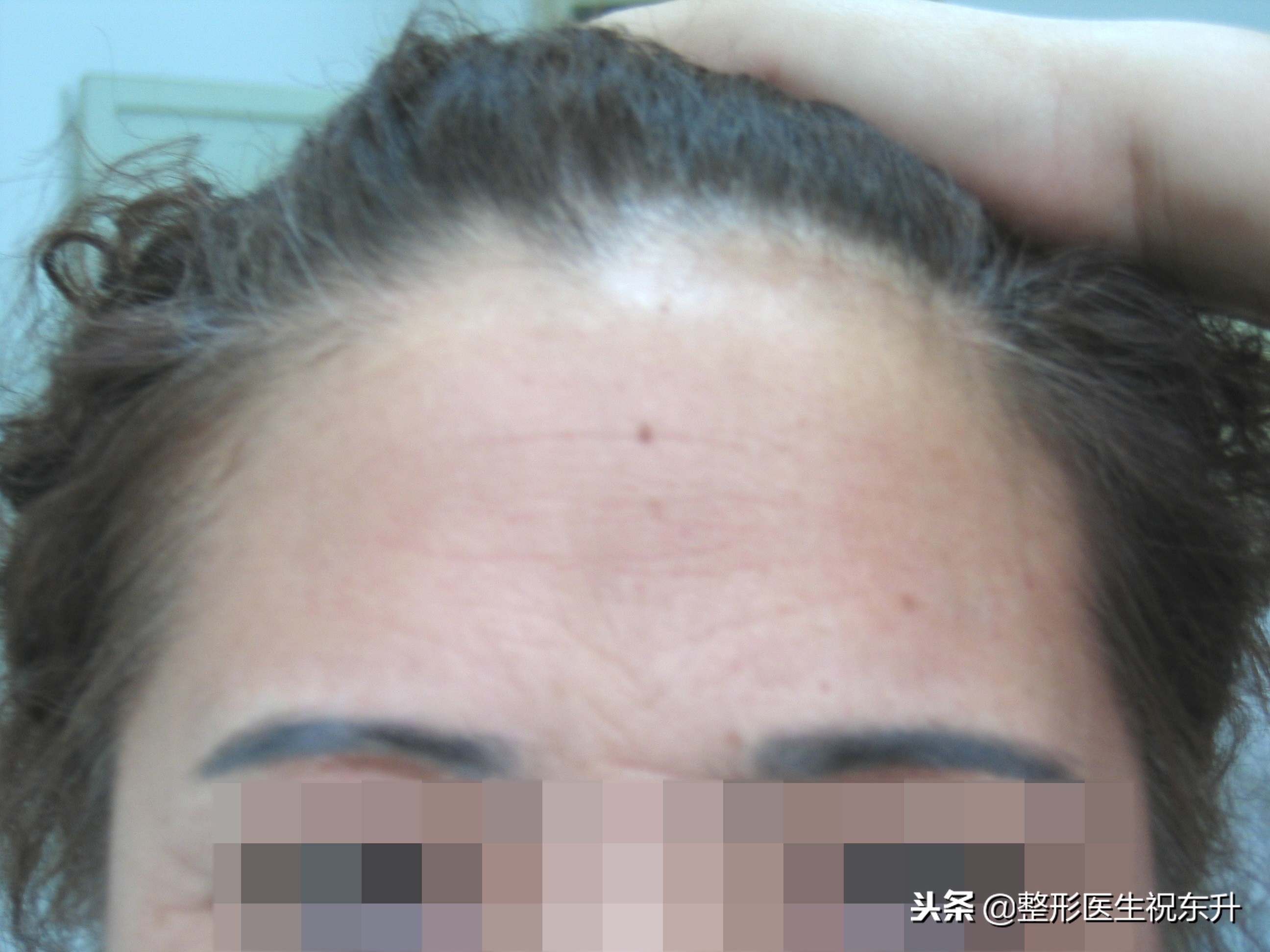 额颞部除皱去抬头纹怎么样,拉皮除皱抬头纹全过程视频