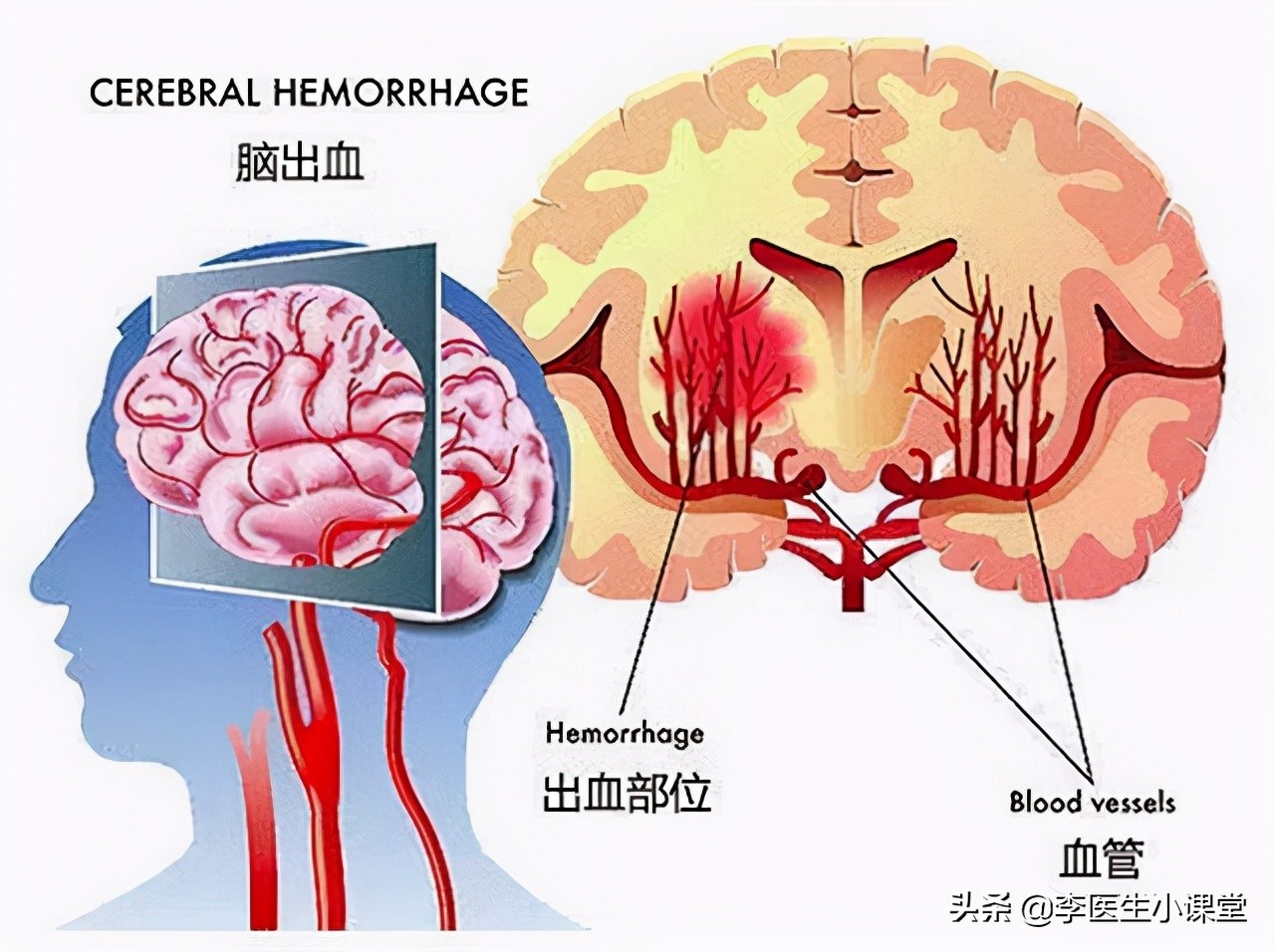 家人脑出血住院家庭怎么办,家里人出现脑出血家庭急救方法