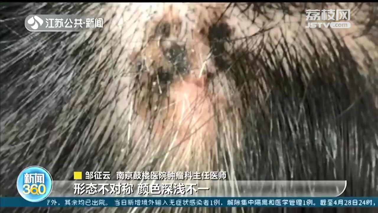 头皮黑色素瘤原因,头皮黑痣长大了怎么办