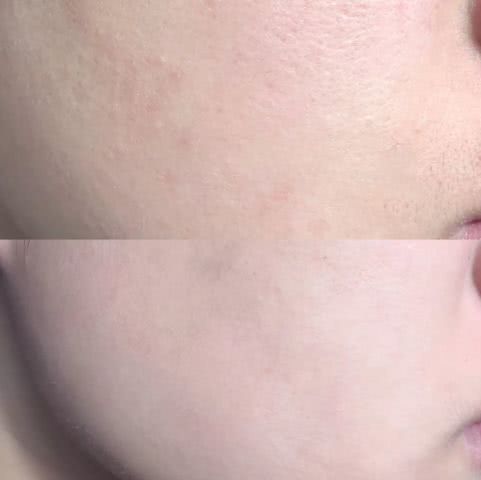 淡斑祛痘印什么产品最有效,淡斑美白祛痘印