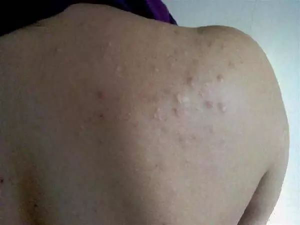 背后长痘痘用什么药膏,喝啤酒背后长痘痘是什么情况