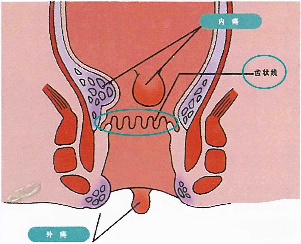 肛肠疾病的四大金刚：痔疮、肛裂、肛瘘、肛周脓肿的自检与预防