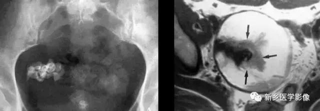 左肾可见高密度影不是结石,结节状高密度影是结石吗