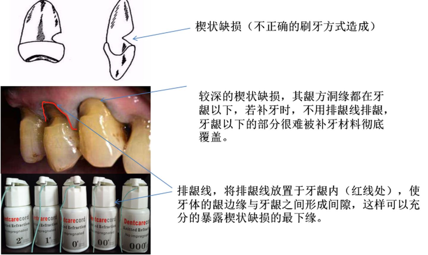 补牙后敏感遇冷热疼痛,补牙后牙齿敏感怎么处理最好