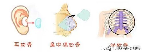 没鼻梁耳软骨隆鼻可以吗,肋软骨隆鼻鼻子好堵