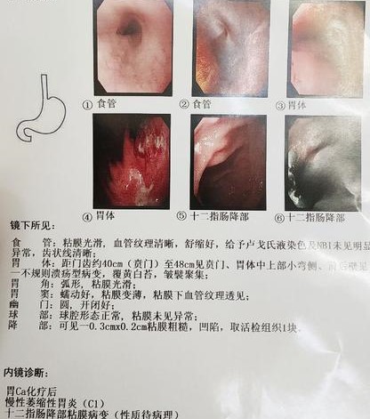 胃癌术后辅助化疗一次多少钱,可切除胃癌新辅助化疗首选方案