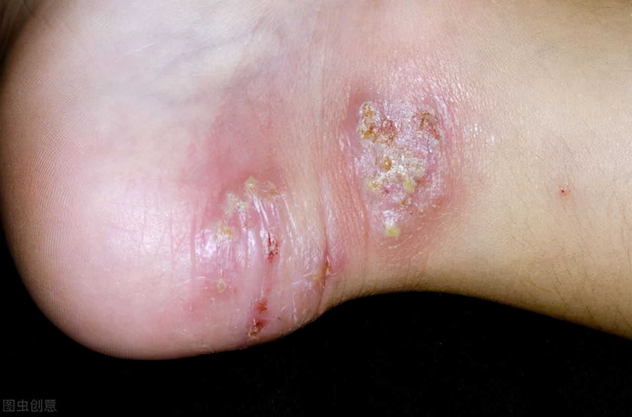 脚板有小水泡痒怎么处理,脚部起了小水泡要不要戳掉