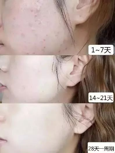 李佳琦推荐控油祛痘除螨洗脸皂,李佳琦推荐洗面奶祛黑头粉刺