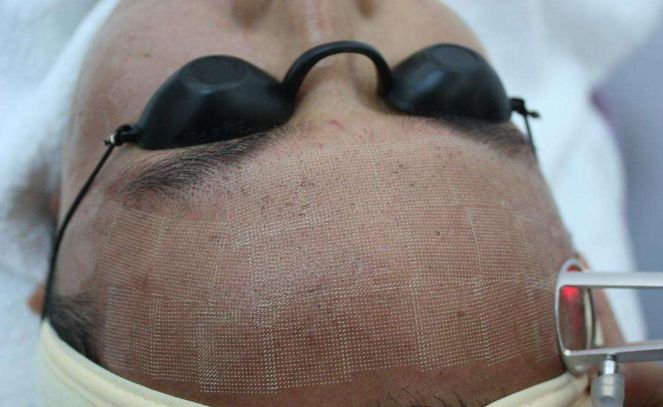 鸡皮疙瘩怎么拯救,治疗鸡皮肤最快的方法