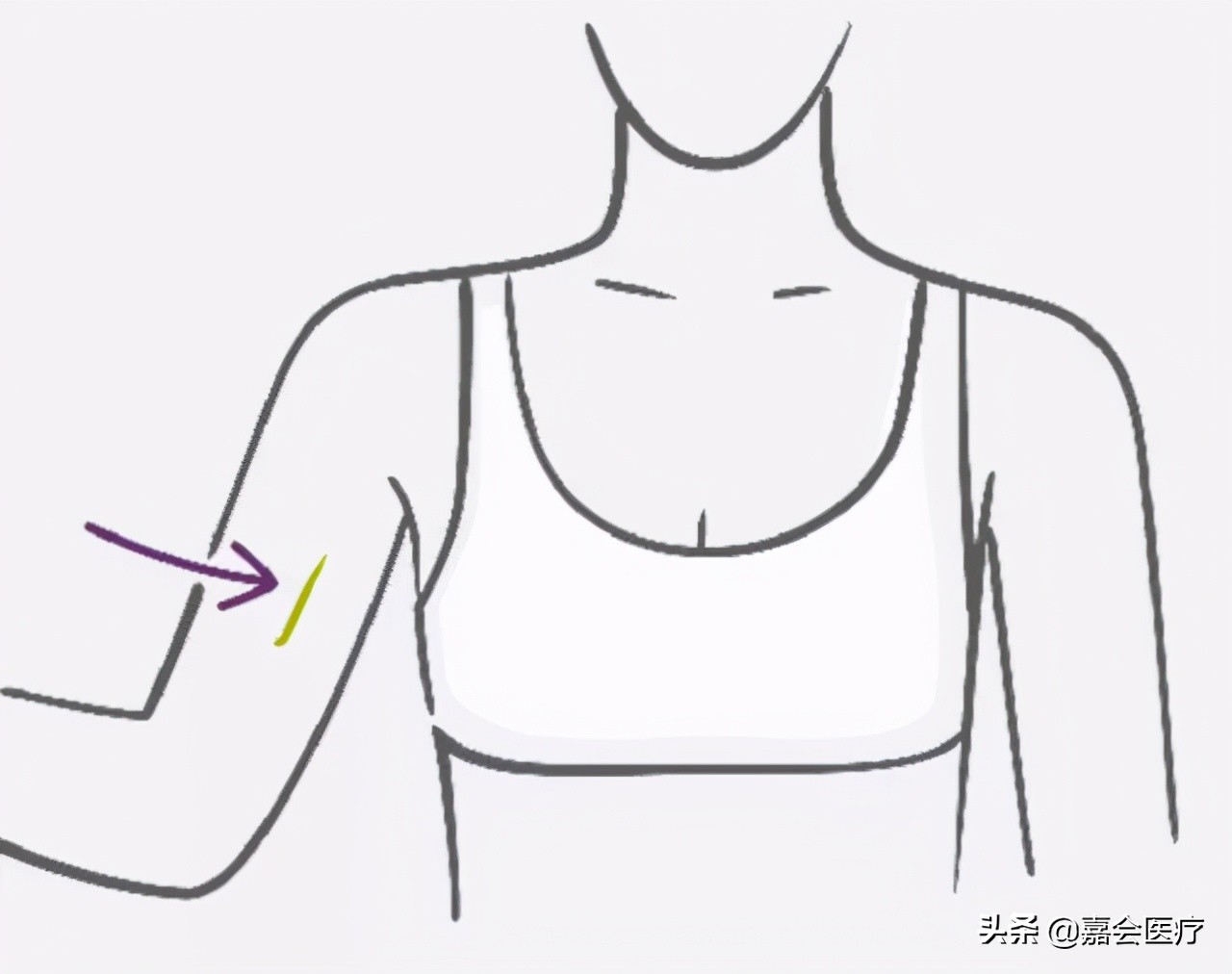 皮下埋植避孕药男的能做吗,未婚未孕可以皮下埋植避孕吗