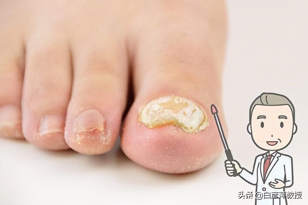 灰指甲是灰色的吗？灰指甲真的会传染吗？皮肤科医生告诉你