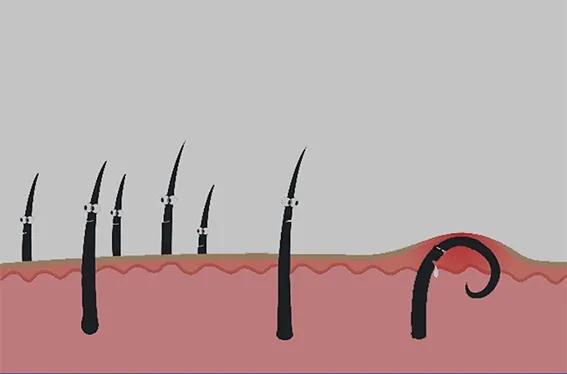 屁屁中间毛太多，也可能是病吗？