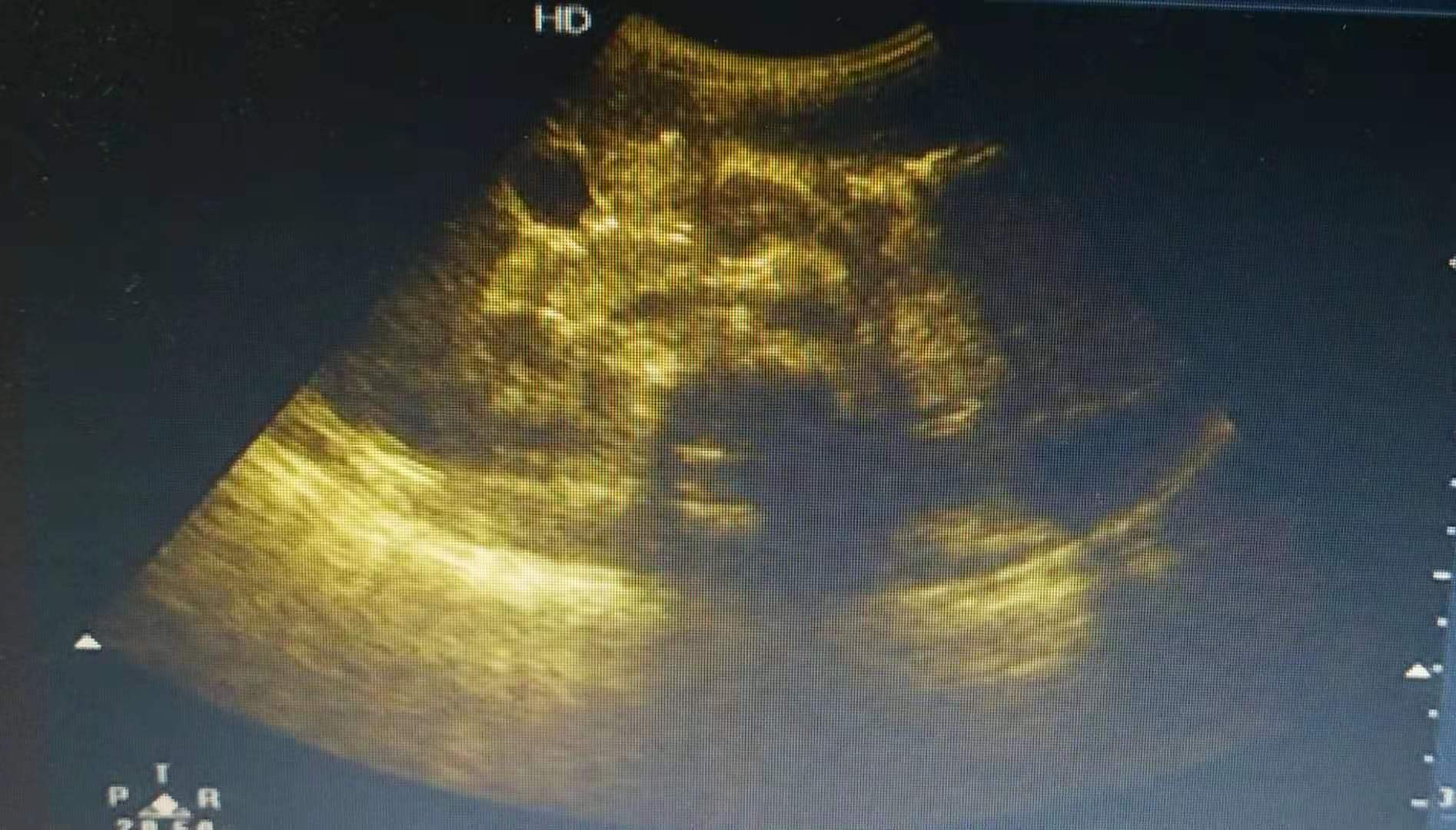 8岁男孩得了腮腺炎,六岁儿童忽然腮腺一侧肿大疼