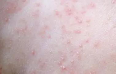 小孩身上起疙瘩总是挠,孩子身上过敏起痱子一样的疙瘩