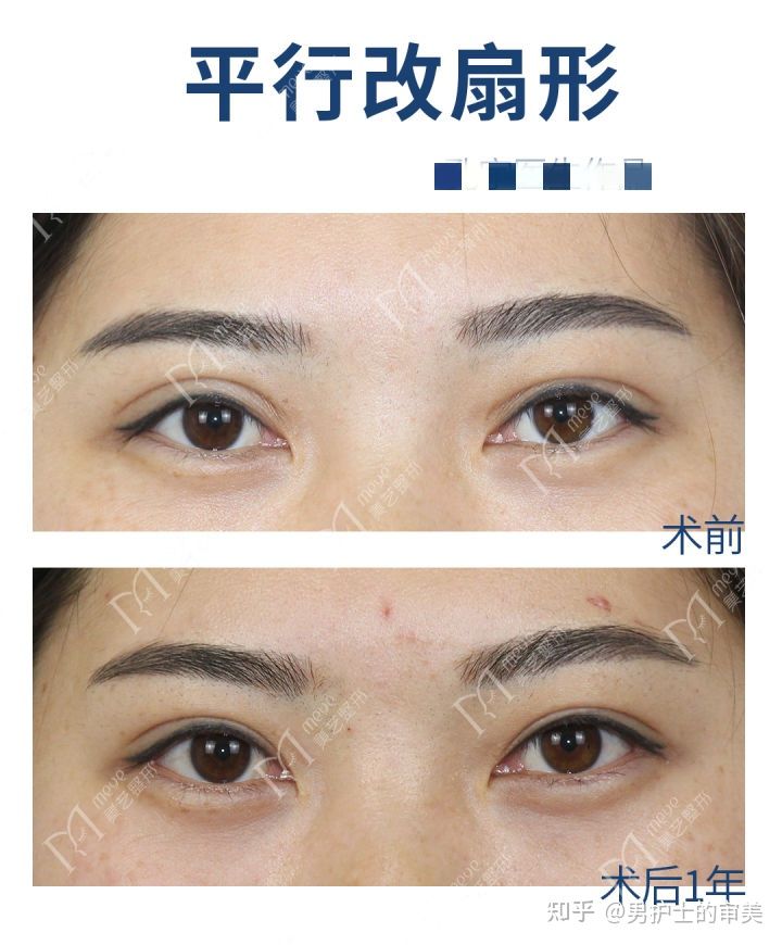 开扇形双眼皮上扬和下垂,做双眼皮后眼尾弧度有个拐弯