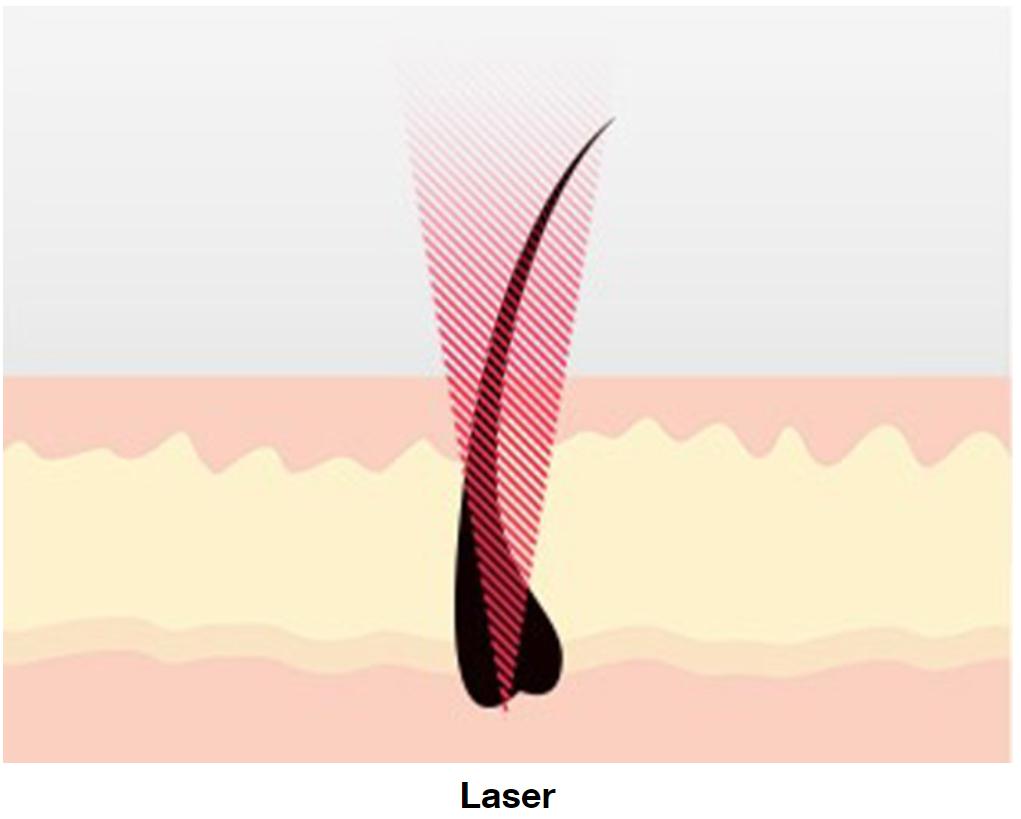 热玛吉提拉紧致皮肤的5个原理,热玛吉光子嫩肤真实感受分享