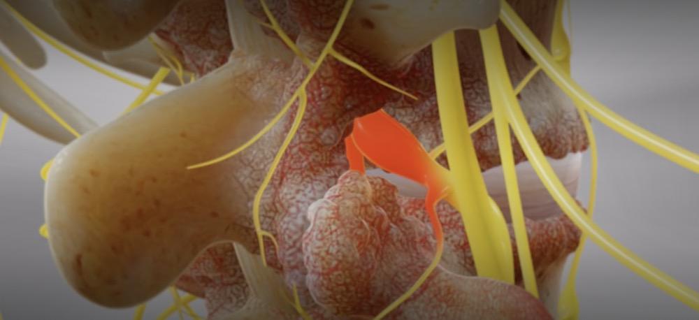 腰椎管狭窄症的基本诊断手段习题,骨科专家讲述腰椎管狭窄的原因