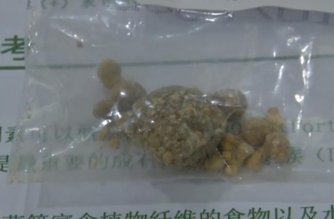 11岁小女孩胆结石怎么得的,10岁的孩子得了胆结石怎么办