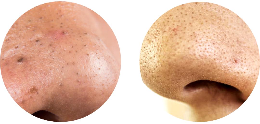 黑头毛孔粗大到底怎么治,黑头毛孔粗大有没有必要去改善