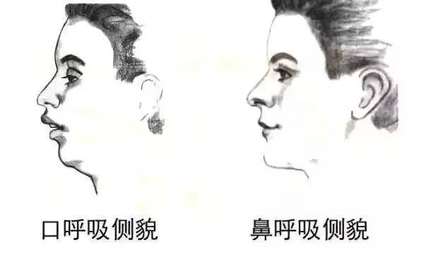 “龅牙”是深覆颌还是深覆盖，两者如何区分？还能不能治疗？