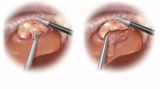 肝囊肿为什么会变成肝癌,肝囊肿怎么发展成肝癌