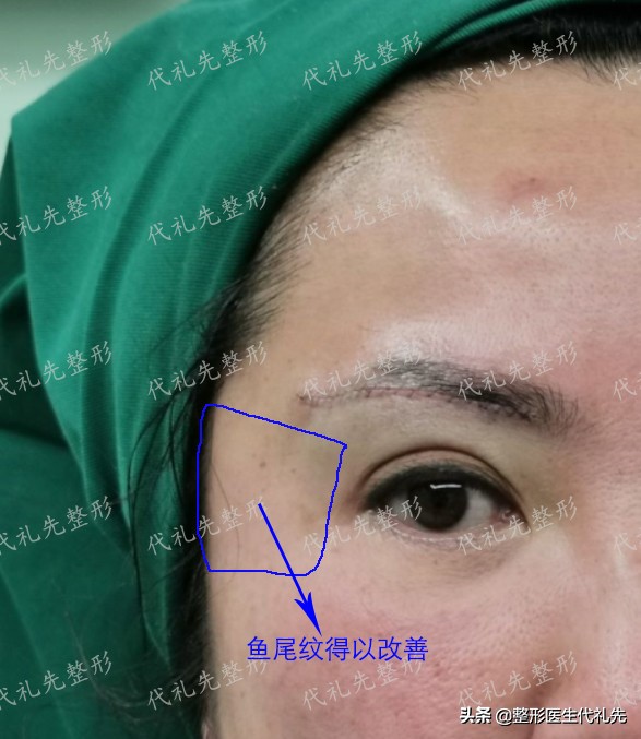 筋膜提眉术后遗症有多严重,提眉手术固定筋膜有后遗症吗