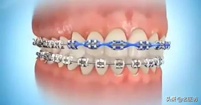 牙齿稀疏牙缝小怎么矫正效果最好,牙缝正畸后有概率还会恢复牙缝吗