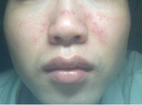 皇家雨燕教你痘痘肌の正确保养方式