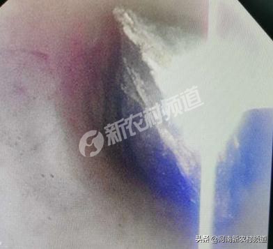 72岁老人误吞枣核后续,81岁老人误吞杏核