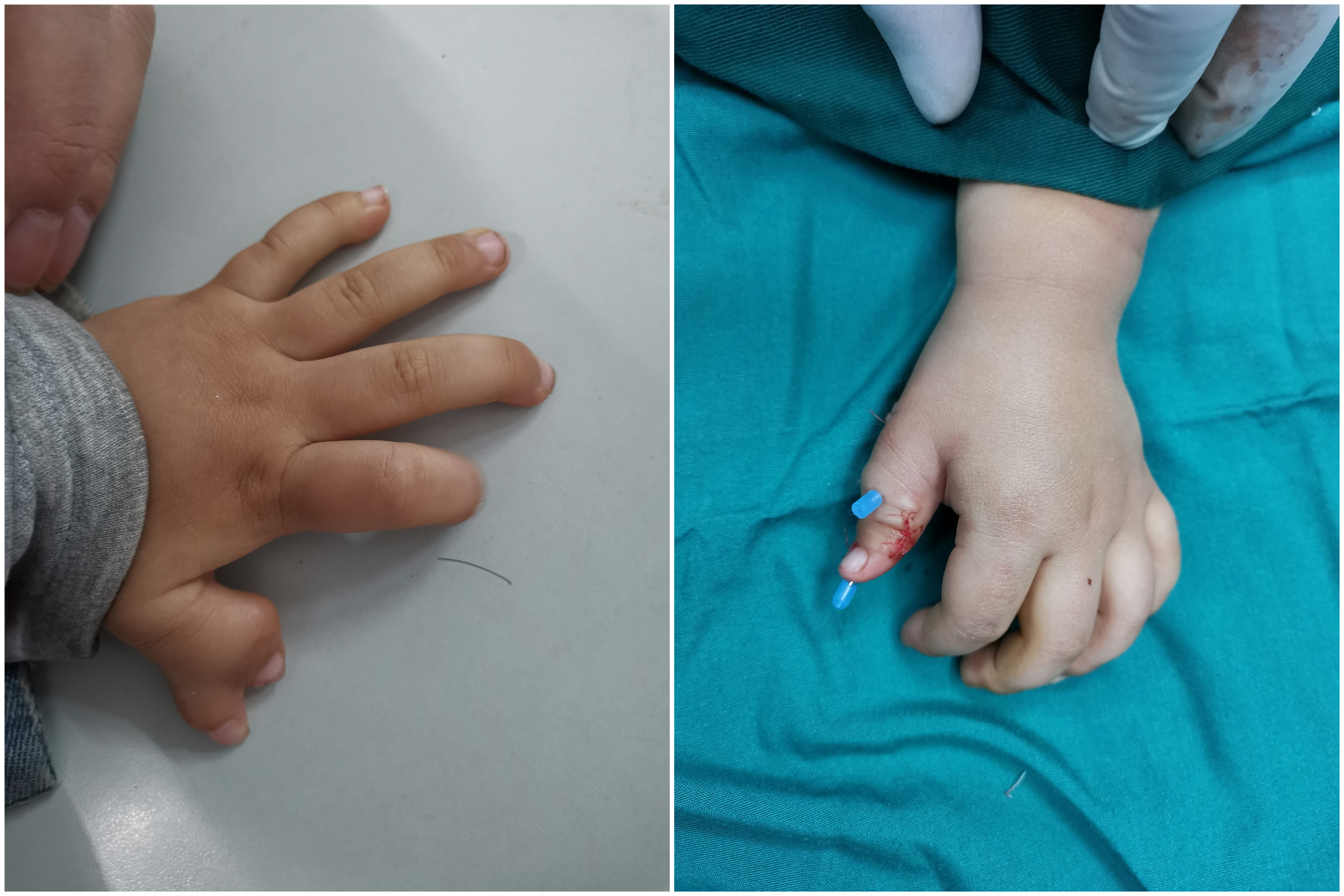 六指宝宝手术可以恢复正常吗,六指宝宝哪里治疗最好