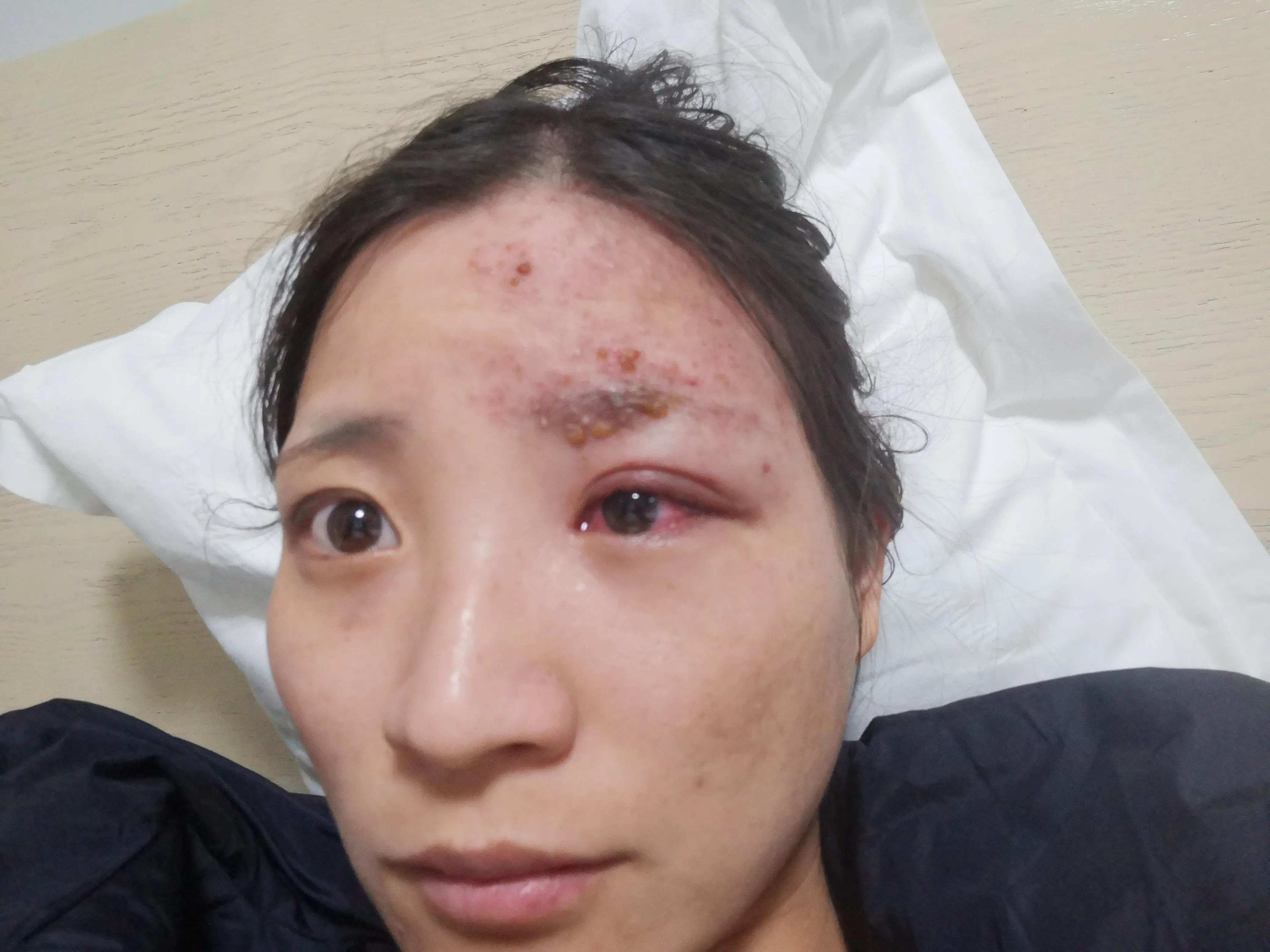 孕妇得了带状疱疹病毒怎么办,孕中期得带状疱疹该怎么办