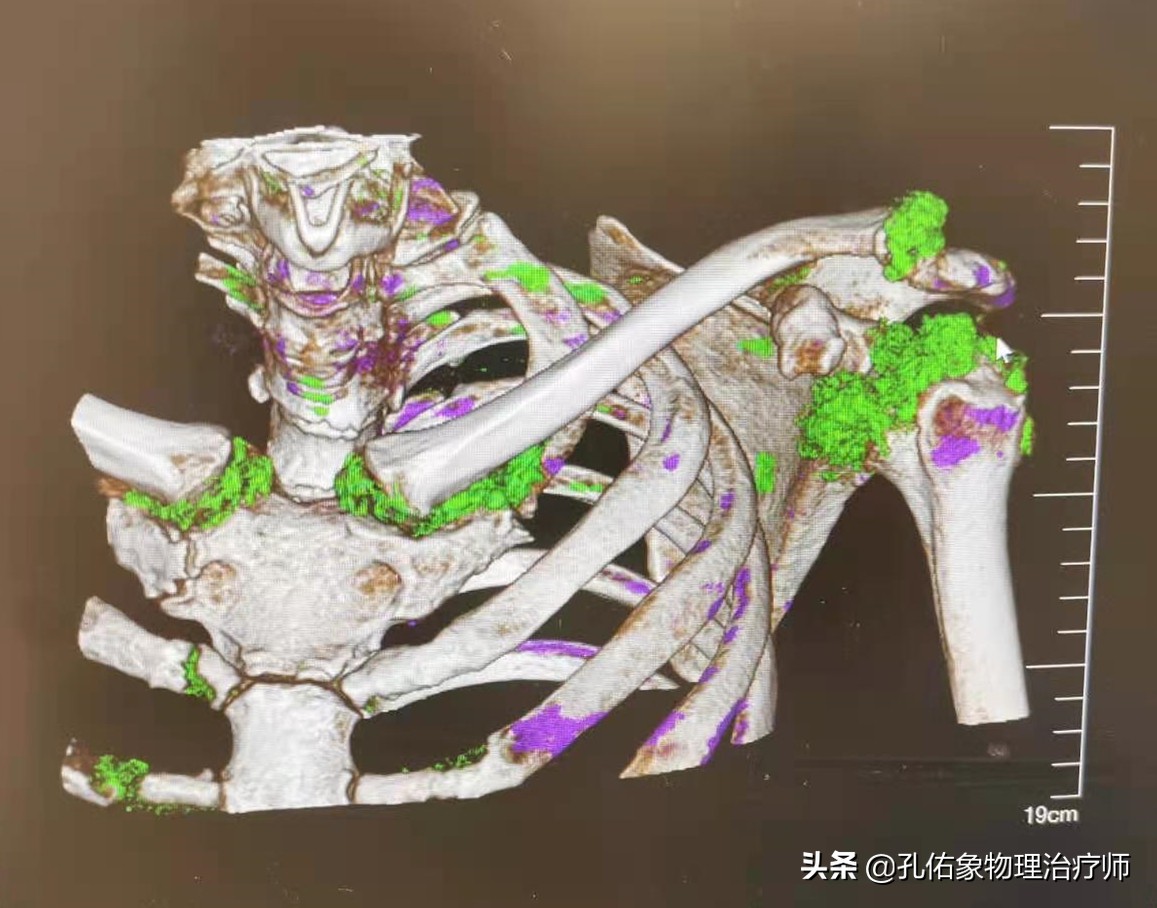 肩膀疼痛是怎么回事?本文告知您9种病因,让您再也不盲目咨询